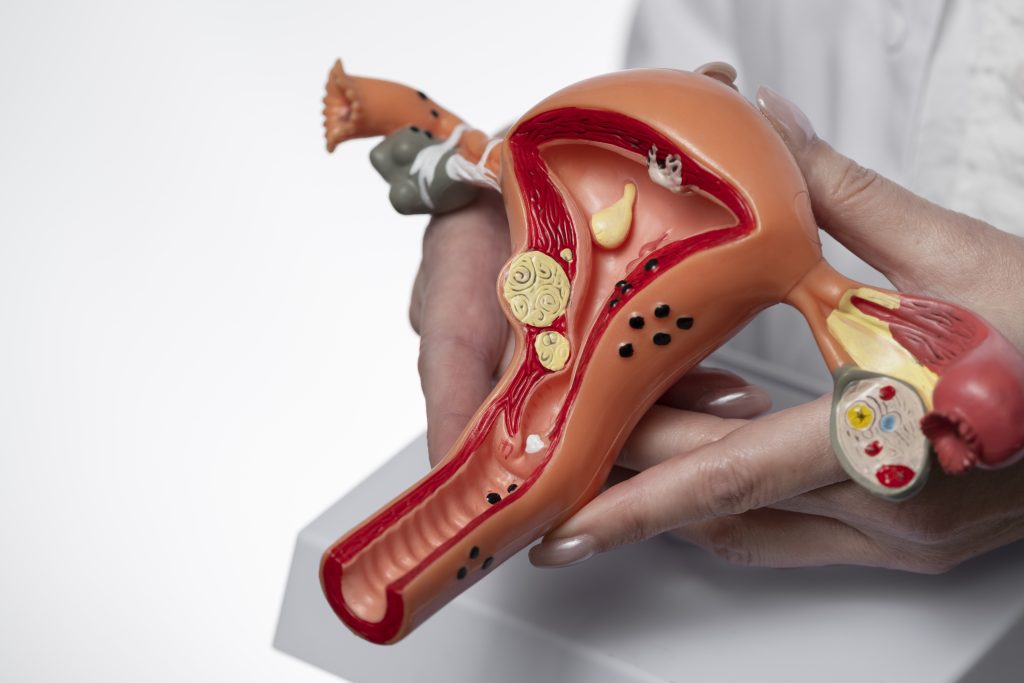 Uterus with fibroids